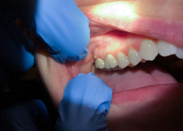 Best Emergency Care for Gum Disease in Lone Grove, OK